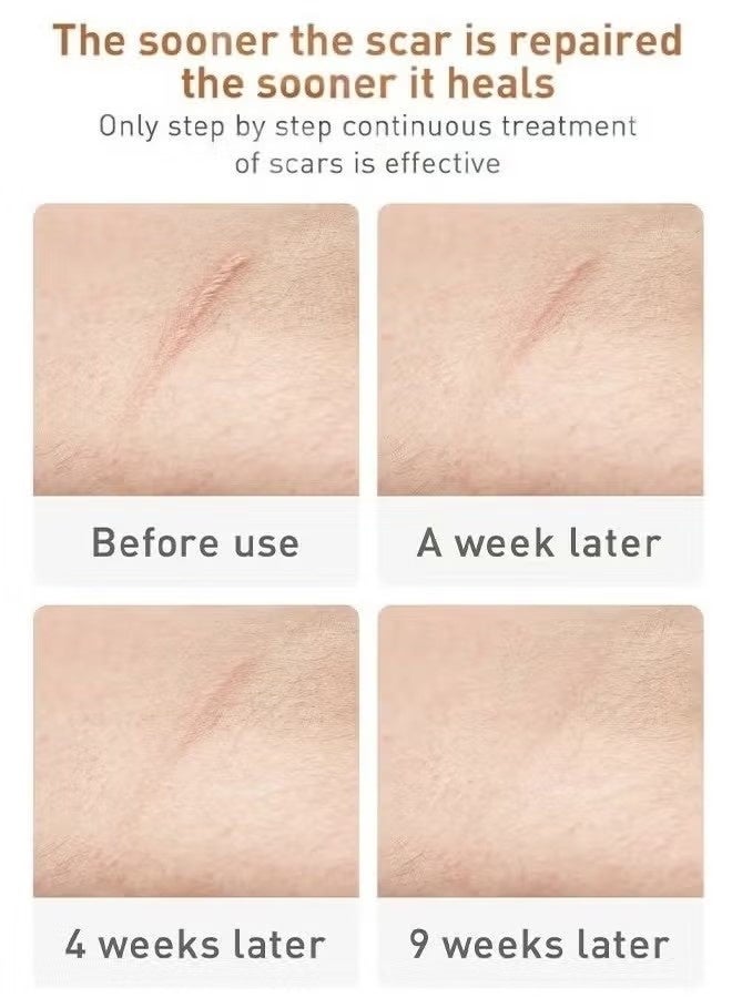 لان بينا جل للعناية بالبشرة ، كريم إصلاح الندبات العشبية 30 جم ، جل ندبات ، جل إصلاح البشرة ، مكونات نباتية طبيعية ، إصلاح الندبات القديمة والجديدة بشكل فعال ، الحروق ، علامات التمدد ، حب الشباب ، حروق الشمس ، 30 جرام - Image 4